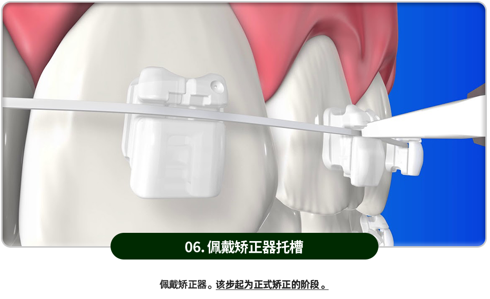 06)-교정장치-브라켓-부착-교정장치를-부착합니다-이제-본격적으로-교정을-시작하는-단계입니다