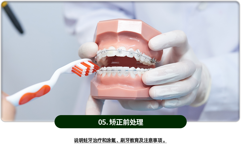 05)-교정-전-처치-충치치료와-불소도포,-잇솔질-교육,-주의사항을-설명합니다