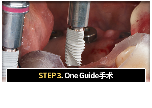 3단계-원가이드-시술-맞춤형-원가이드를-장착하여-계획된-위치에-임플란트-식립