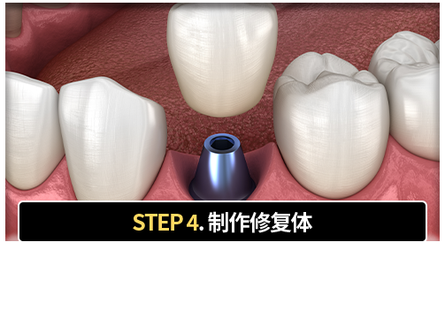 4단계-보철물-제작-인접치와-균형,-교합을-고려한-맞춤-보철물-제작-및-장착