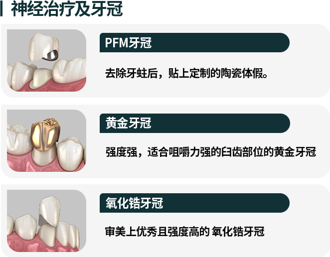 신경치료-및-크라운-종류1-PFM-크라운-충치를-제거한-후-맞춤-제작된-세라믹-보철물을-부착합니다-종류2-골드-크라운-강도가-강해-씹는힘이-강한-어금니-부위에-적합합니다-종류3-지르코니아-크라운-심미적으로-우수하고-강도가-높습니다