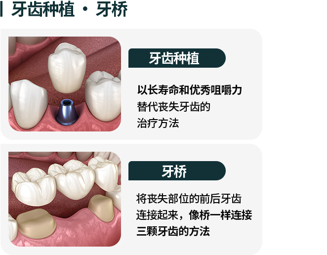 임플란트/브릿지-임플란트-오랜-수명과-우수한-저작력으로-상실된-치아를-대체하는-치료-방법-브릿지-상실-부위-앞-뒤-치아를-이어서-다리처럼-세-개의-치아를-연결하는-방법