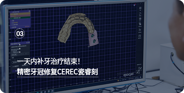 하루만에-보철치료-끝!-정밀보철세렉