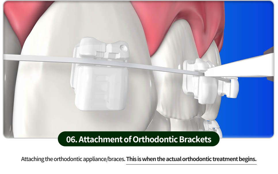 06)-교정장치-브라켓-부착-교정장치를-부착합니다-이제-본격적으로-교정을-시작하는-단계입니다