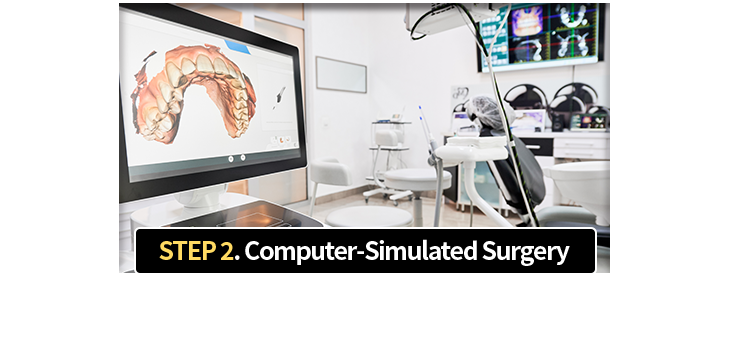 2단계-컴퓨터-모의-수술-컴퓨터-모의-수술을-통해-적합한-수술-계획-수립