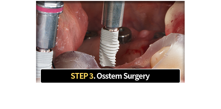 3단계-원가이드-시술-맞춤형-원가이드를-장착하여-계획된-위치에-임플란트-식립
