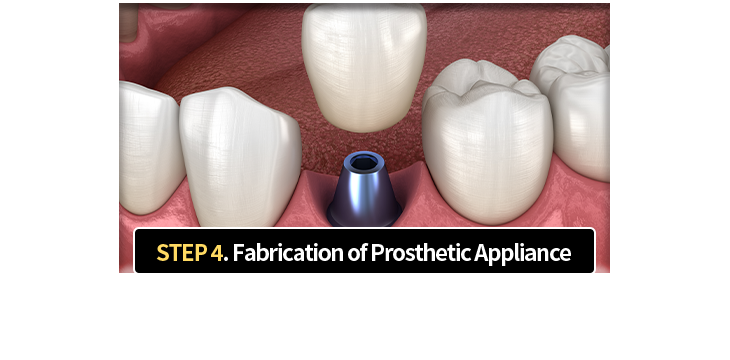 4단계-보철물-제작-인접치와-균형,-교합을-고려한-맞춤-보철물-제작-및-장착