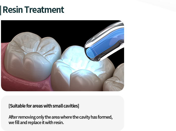 레진치료-충치가-작은-부위에-적합-충치가-생긴-곳만-살짝-제거한-후-긁어낸-부위를-레진으로-채워-메꿔줍니다