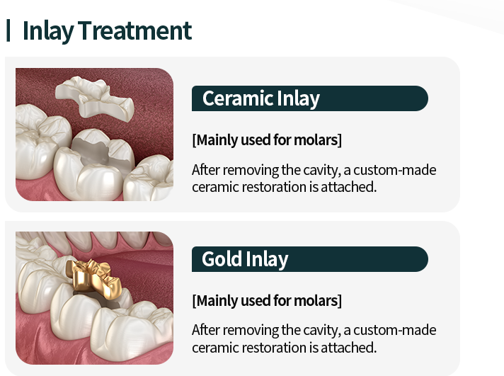인레이-치료-종류1-세라믹-인레이-어금니에-주로-사용-충치를-제거한-후-맞춤-제작된-세라믹-보철물을-부착합니다-종류2-골드-인레이-어금니에-주로-사용-충치를-제거한-후-맞춤-제작된-합금-보철물을-부착합니다
