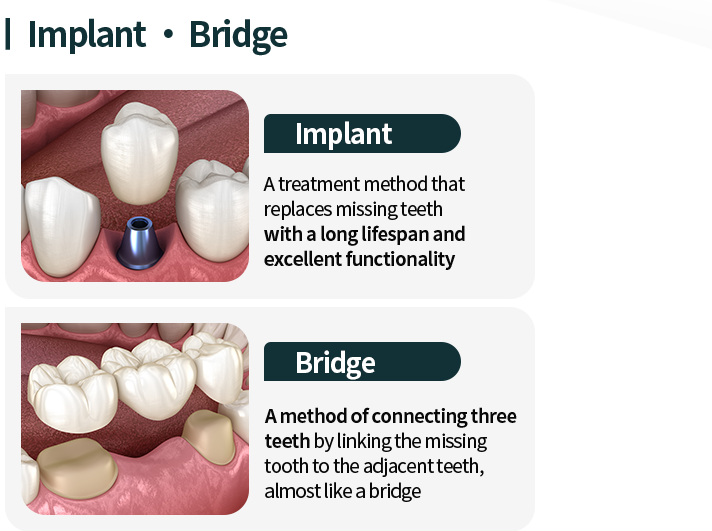 임플란트/브릿지-임플란트-오랜-수명과-우수한-저작력으로-상실된-치아를-대체하는-치료-방법-브릿지-상실-부위-앞-뒤-치아를-이어서-다리처럼-세-개의-치아를-연결하는-방법