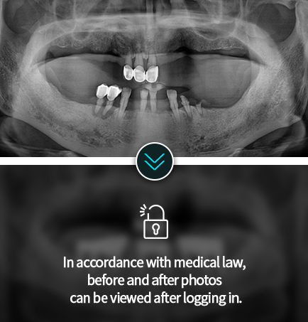임플란트-전후사진1