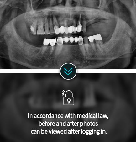 임플란트-전후사진3