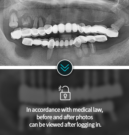 임플란트-전후사진4