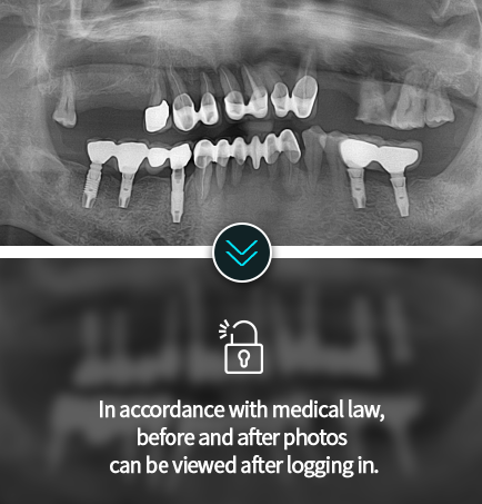 임플란트-전후사진5
