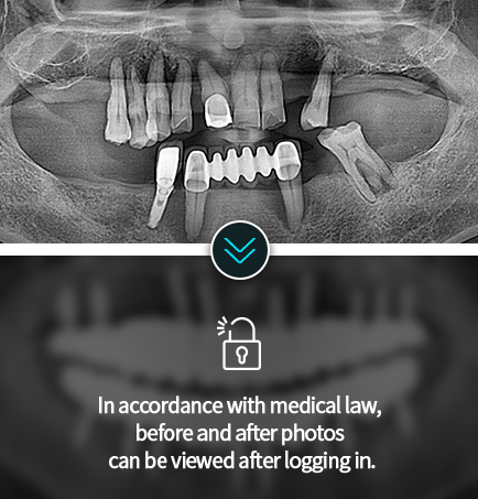 임플란트-전후사진6