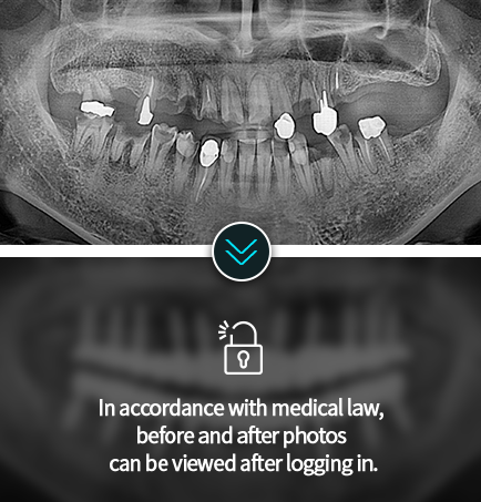임플란트-전후사진7