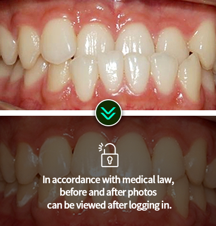치아교정-전후사진1