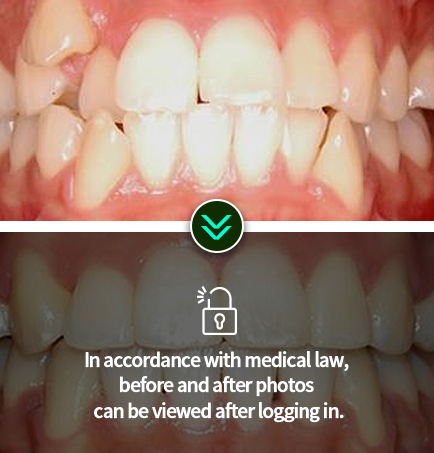 치아교정-전후사진2