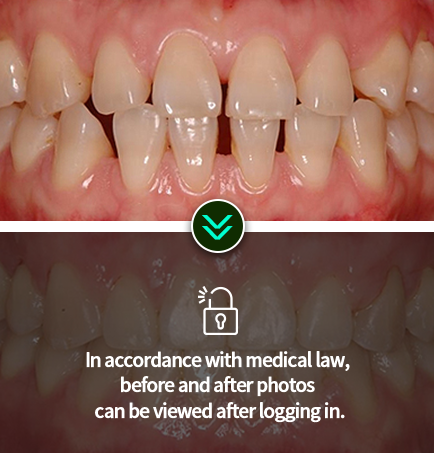 치아교정-전후사진3