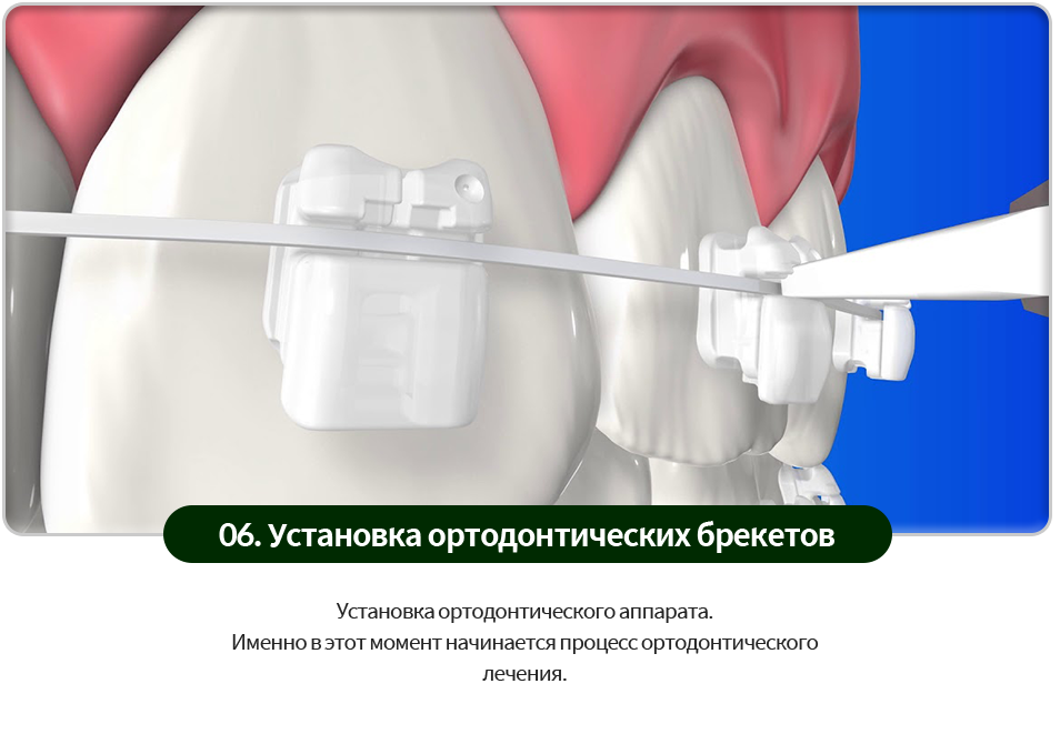 06)-교정장치-브라켓-부착-교정장치를-부착합니다-이제-본격적으로-교정을-시작하는-단계입니다