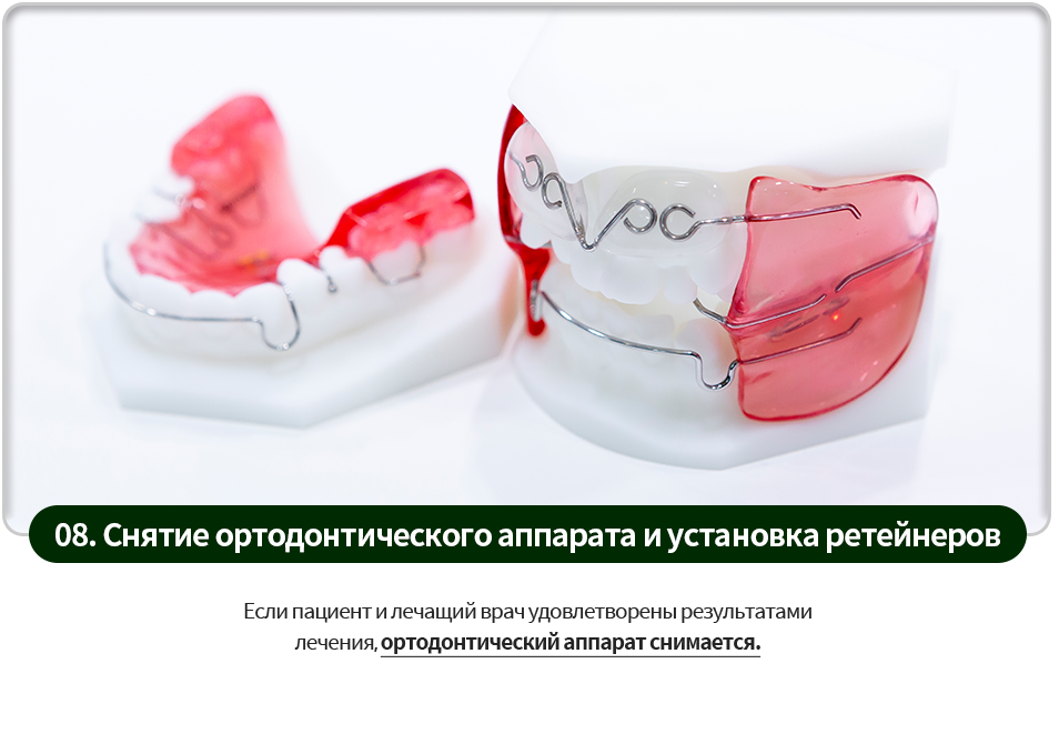 08)-교정장치-제거와-유지장치-장착-환자분과-담당-의사가-교정-결과에-만족하면-교정장치를-제거합니다-일정기간-동안-유지장치를-부착해야합니다
